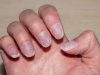 Nail Fungus Be Gone: Mastering Care Techniques for Healthy, Happy Nails!