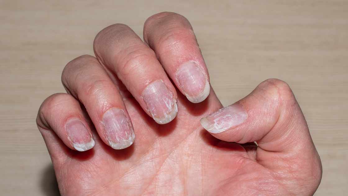 Nail Fungus Be Gone: Mastering Care Techniques for Healthy, Happy Nails!