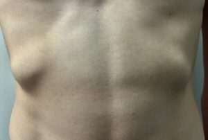 Noticeable Ribs Why Are My Ribs Visible? Understanding Causes and Solutions - Daily Peter
