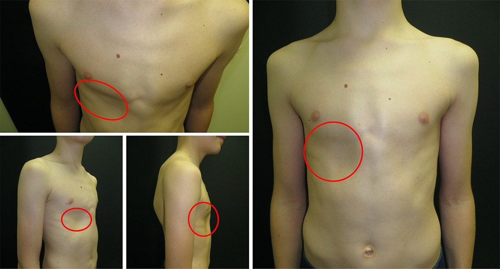 How to Address Visible Ribs (If Desired)